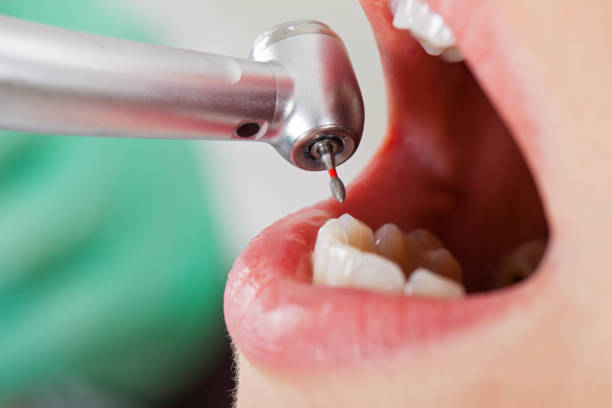 Best Emergency Root Canal Treatment in Hudson, MI